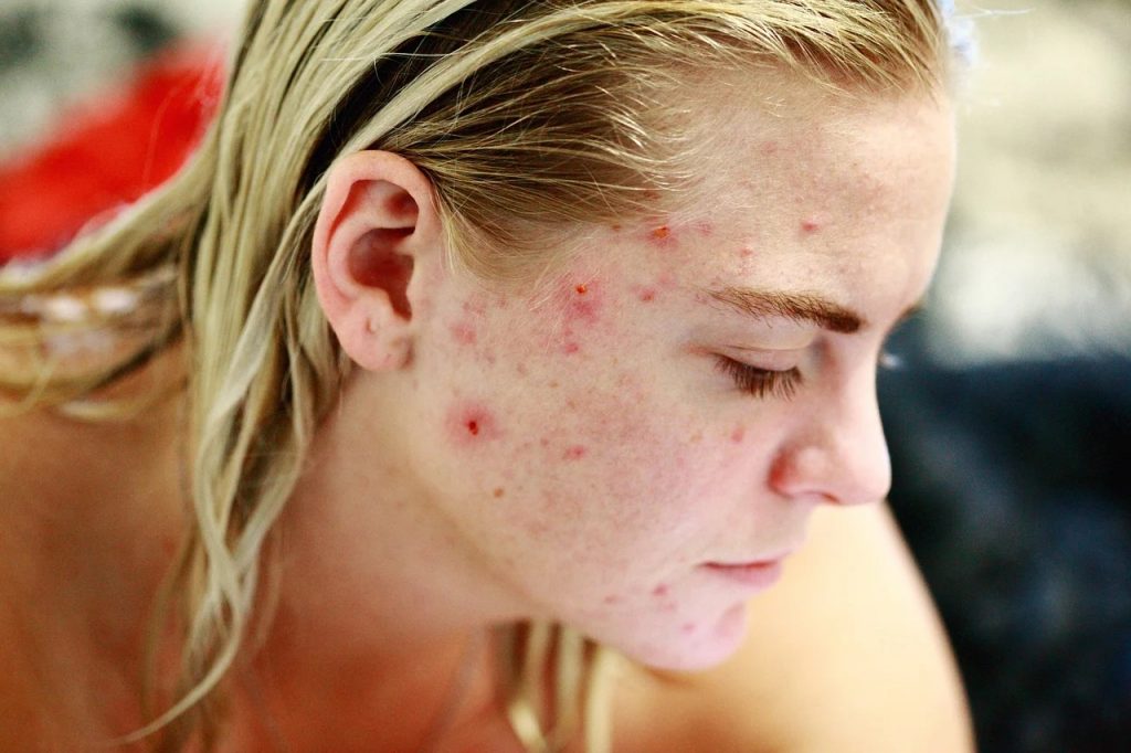 Produse cosmetice antiacnee